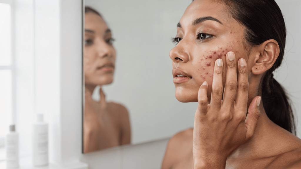 When Iron Supplements Can Make Acne Worse
